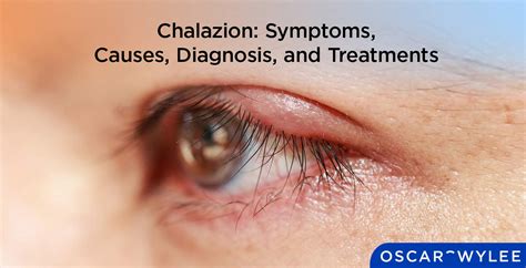 chalazion and apple cider vinegar|images of chalazion eyelid cyst.